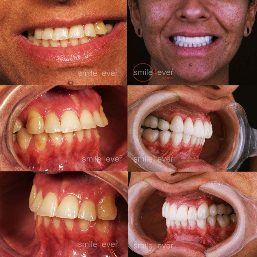 full mouth restoration mexico cost from tijuanadentalcenter.com