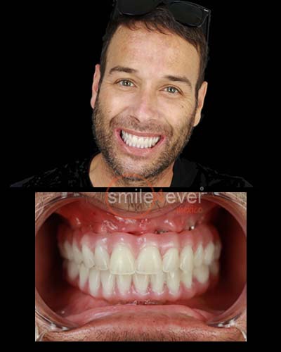 all on 4 dental implants mexico cost from tijuanadentalcenter.com
