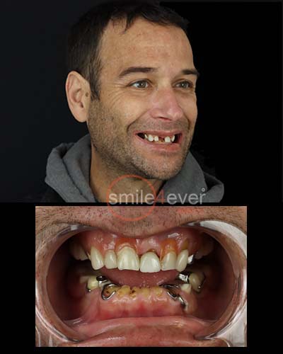 all on 4 dental implants tijuana mexico from tijuanadentalcente.com