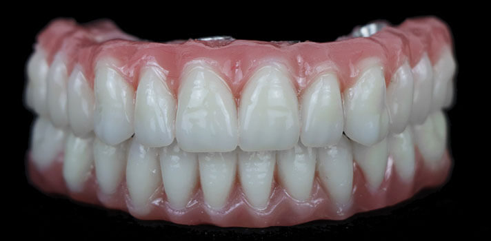 all on 4 denture mexico