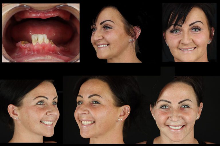 A new started with All on 4 dental implants