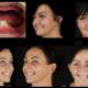 all on 4 dental implants tijuana from tijuanadentalcenter.com