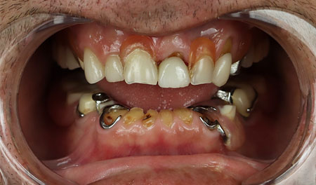 all-on-4-dental-implants-before