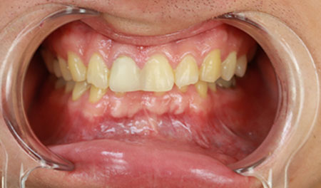 dental-crowns-before