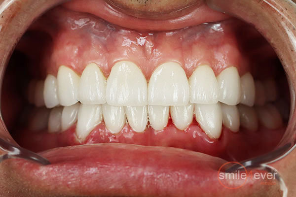 full mouth restoration mexico from tijuanadentalcenter.com