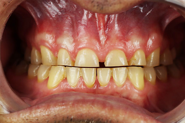 tijuana dental crowns before