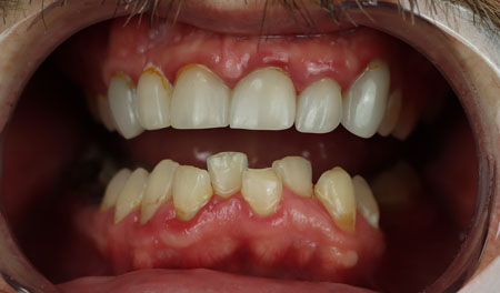 all-on-4-dental-implants-mexico-price-before