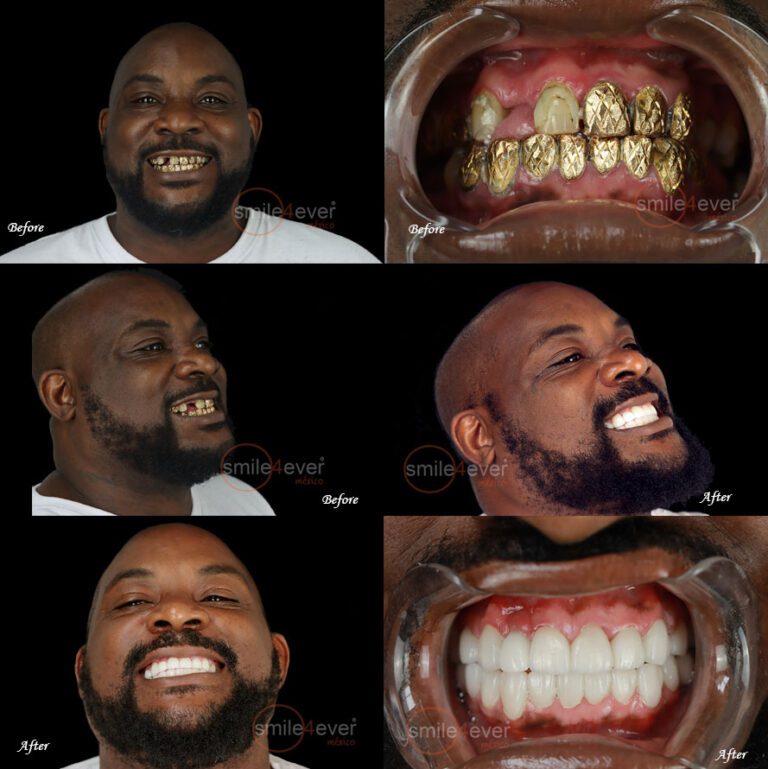 full mouth teeth restoration mexico from tijuanadentalcenter.com