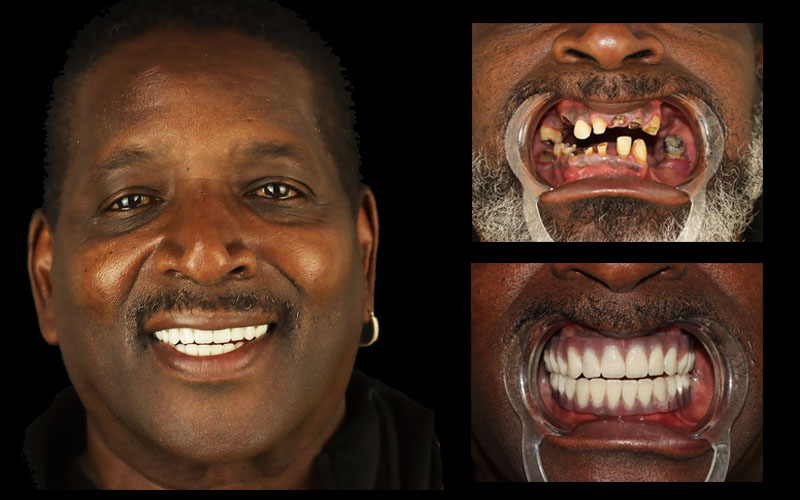 Smiling patient with all-on x dental implants