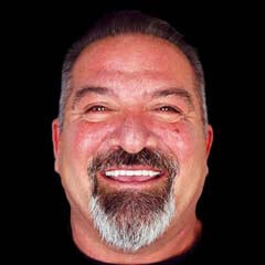 Tijuana dentist performing All-on-4 implant surgery