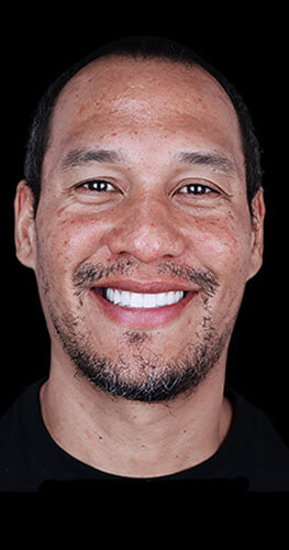 Smiling patient with all-on x dental implants
