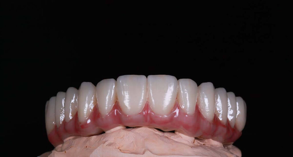 all on 4 dental implants in mexico from tijuanadentalcenter.com