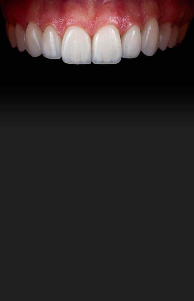 dental veneers in tijuana full arch package