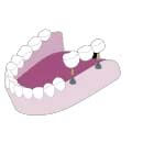 implant supported bridge for multiple missing teeth in Tijuana