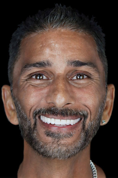 patient before and after dental implants in Tijuana