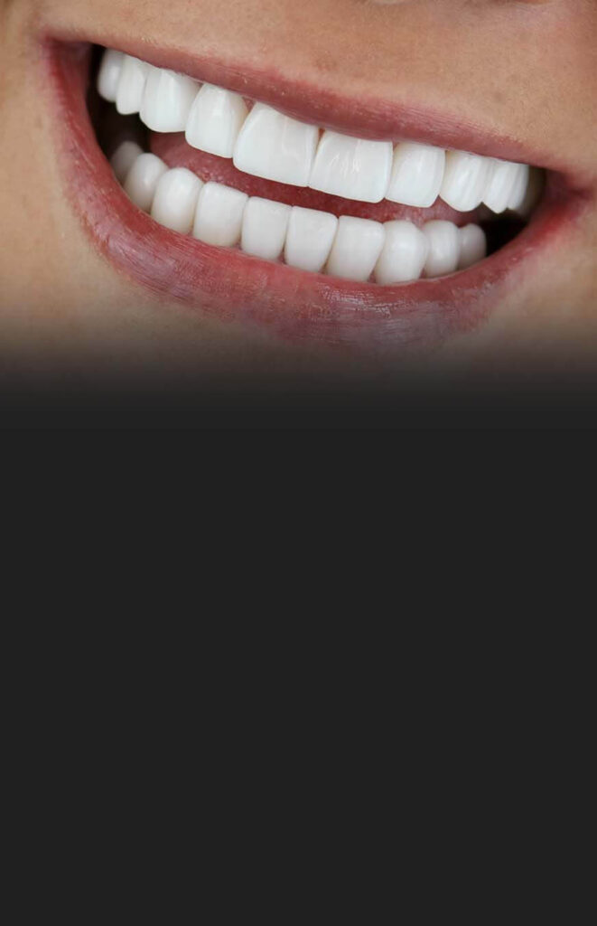 dental veneers in tijuana full mouth package
