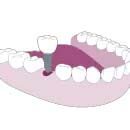 single dental implant placement demonstration Tijuana