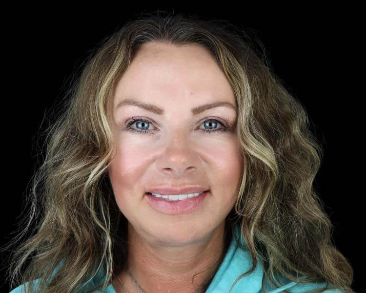 dental crowns in tijuana after picture