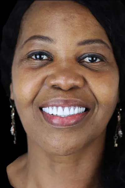 smile gallery with before and after all on 4 dental implants