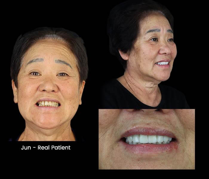 before and after full mouth reconstruction with dentures and dental implants mexico
