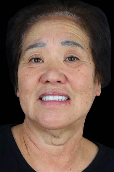 full mouth reconstruction in tijuana mexico case