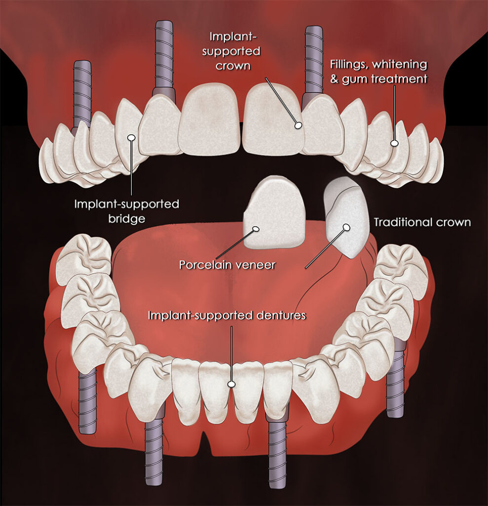 full mouth restoration tijuana mexico options