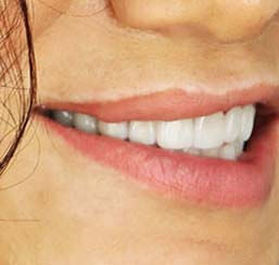 dental crown front tooth