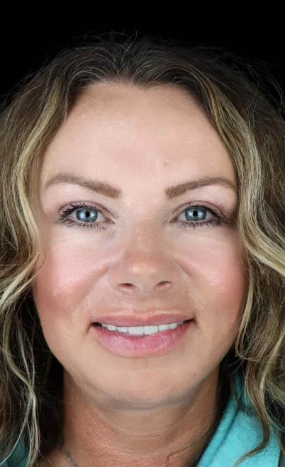 female smiling with a full mouth of dental crowns in Tijuana Mexico