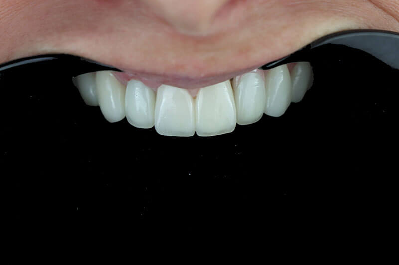 dental crowns in tijuana