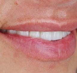 porcelain crowns in tijuana