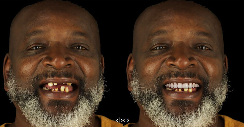 smile design dentistry showing before after case