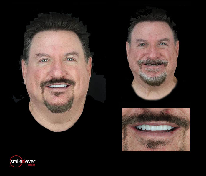 Before and after All-on-4 dental implants result on male patient in Mexico