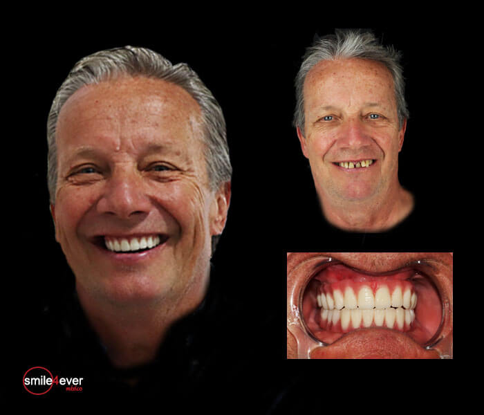Before and after All-on-4 dental implants in Mexico for male patient