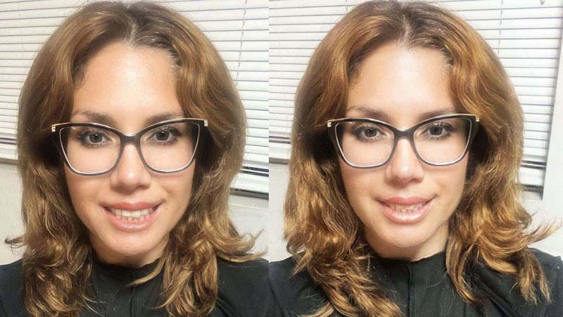 before and after smile design dentistry