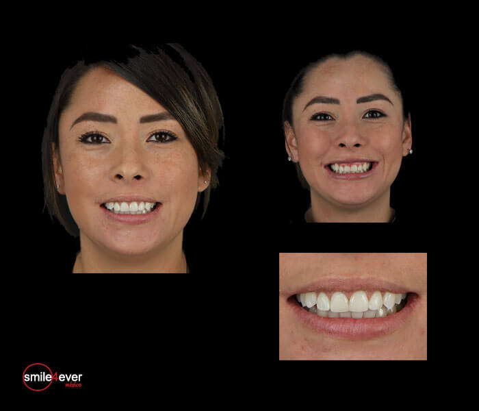 Female patient smiling after dental work in Tijuana, Mexico