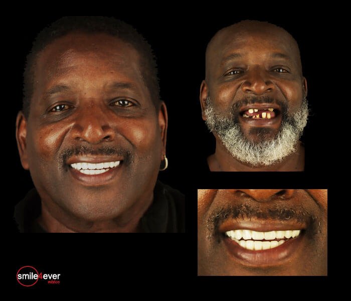 Middle-aged man showing confident smile after dental treatment in Tijuana, Mexico