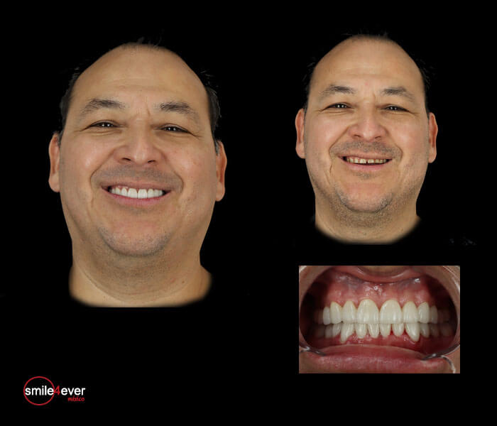 Before and after dental crowns in Tijuana for male patient