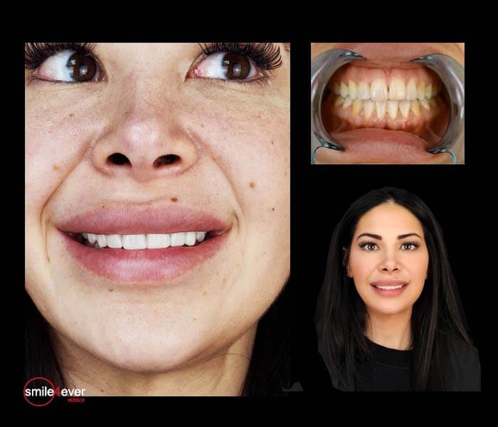 Before after veneers in Mexico on young woman’s smile transformation