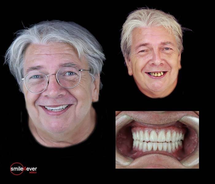 Senior man smiling after full mouth dental restoration in Tijuana, Mexico