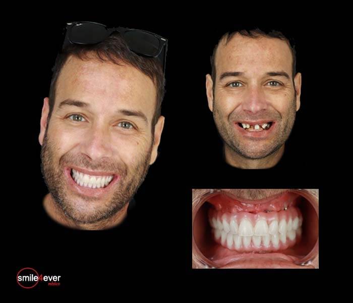 Before and after of 35-year-old man’s smile makeover in Tijuana, Mexico