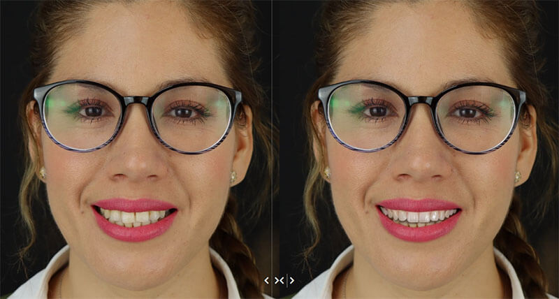 Smile Design Dentistry case