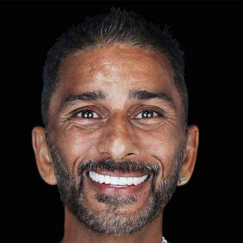 patient smiling after snap-on denture procedure in mexico