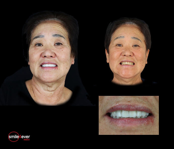 Senior woman smiling after dental implant treatment in Tijuana, Mexico at Smile4ever Clinic