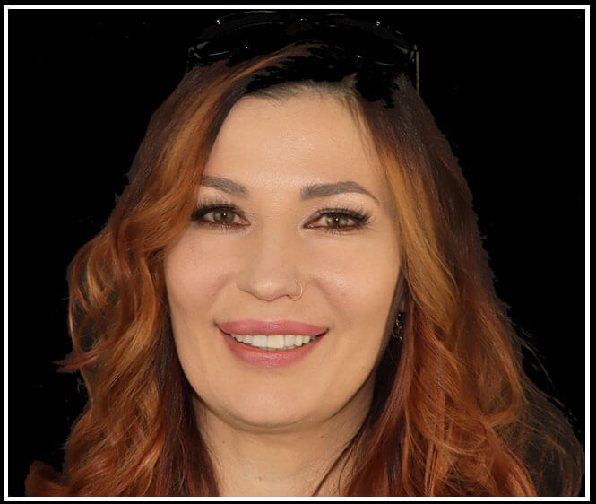 Veneers Financing in Tijuana Mexico