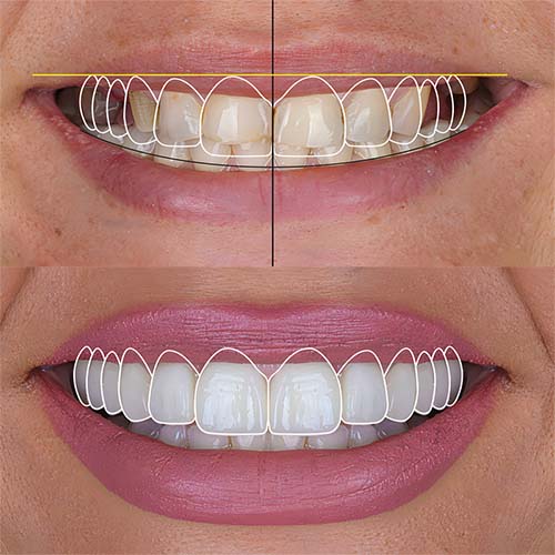 celebrity smile makeover