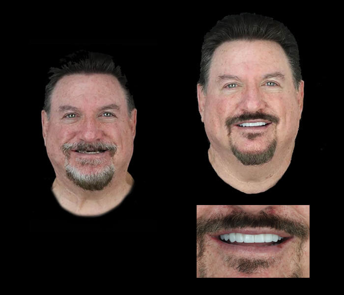 cosmetic dentistry in Mexico