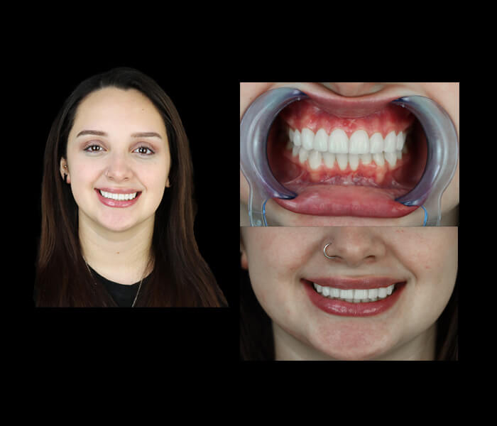smile makeover restoration before after picture