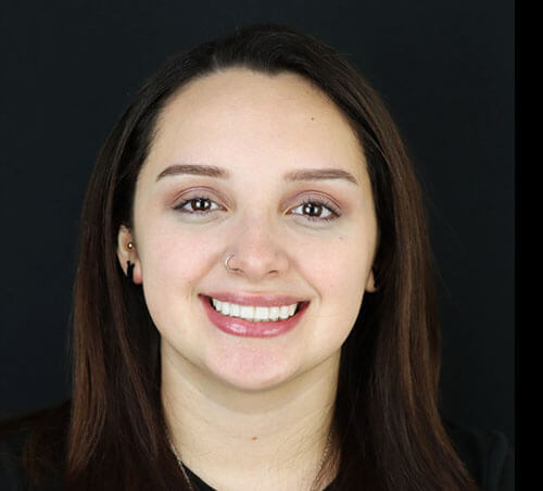 Smile transformation results by Tijuana dentist with dental veneers and crowns