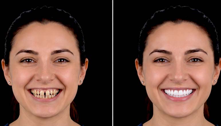 Veneers before and after smile makeover in Tijuana