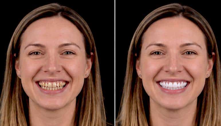 Before and after dental veneers treatment in Tijuana, Mexico